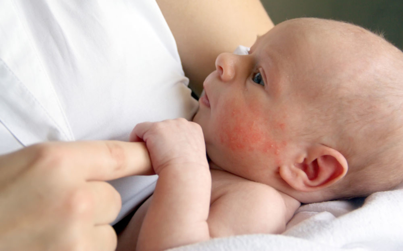 Атопичен дерматит при бебета и малки деца